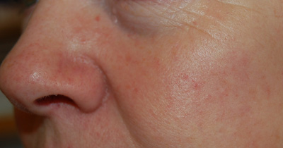 Facial Thread Veins After Treatment